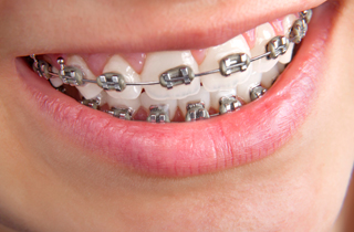 fast braces in duarte