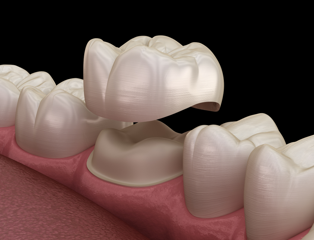 dental crowns